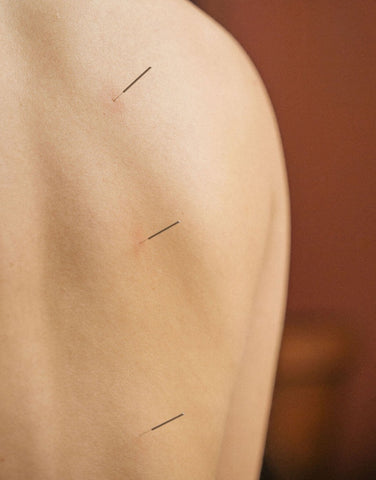 Acupuncture