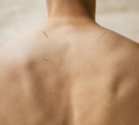 Acupuncture